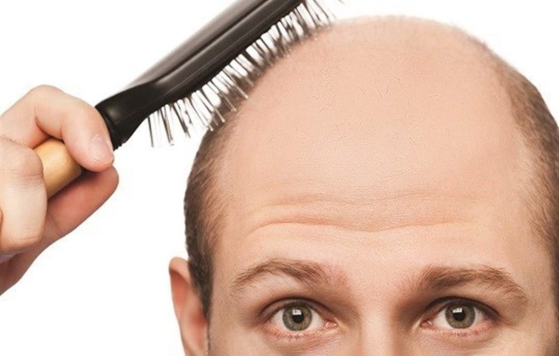 کدام ویتامین‌ها از ریزش مو جلوگیری می‌کنند؟