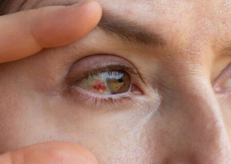 دلایل پارگی رگ خونی در چشم/ چه موقع باید به پزشک مراجعه کنیم؟