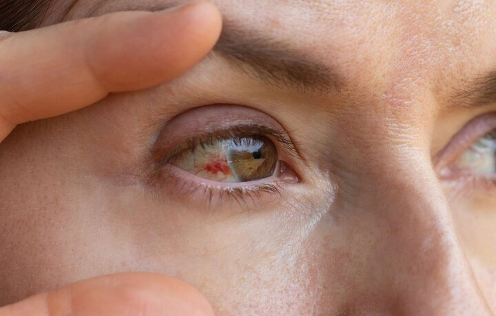 دلایل پارگی رگ خونی در چشم/ چه موقع باید به پزشک مراجعه کنیم؟
